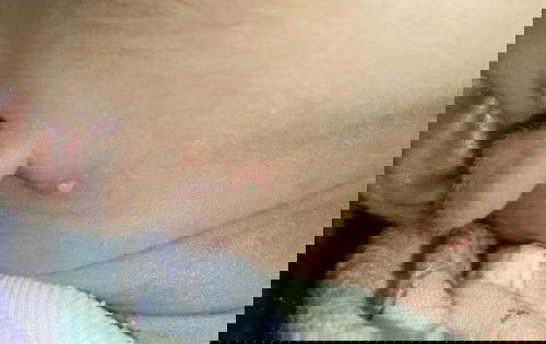 Bintik2 kayak jerawat