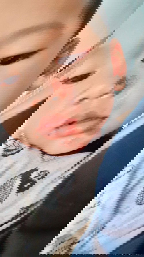 Bayi 15 bulan kena Herpes