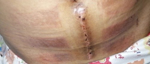 CS Incision