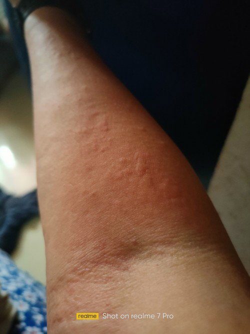 skin rashes
