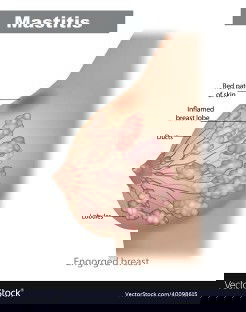 Masitis, Nyeri Payudara saat Menyusui