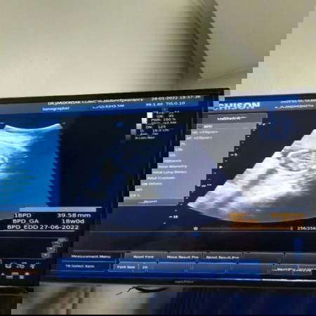 คุณแม่รู้เพศน้องตอนกี่วีคคะ เรา17w 3d แล้วยังไม่รู้เพศน้องเลย หมอบอกอาจเป็นผช. เราอยากได้ผญค่ะ😧