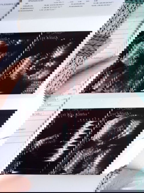 ULTRASOUND (26 WEEKS)