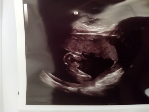Girl or boy ?? Agk² mak² yg dh ad experience mcm mne? Sy scan wktu kndungan 20weeks 6day.Dr ckp boy