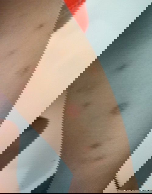 Cream ngilangin bekas luka