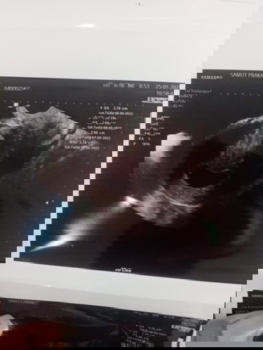 ทำไมซาวไม่เจอตัวอ่อน