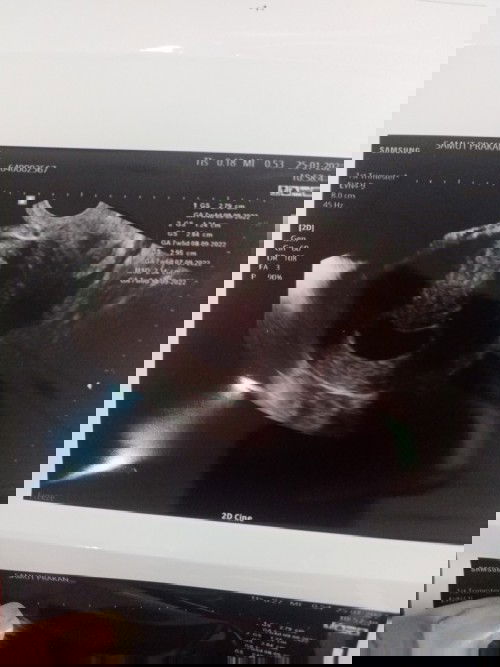 ดูอายุครรภ์จากใบซาว