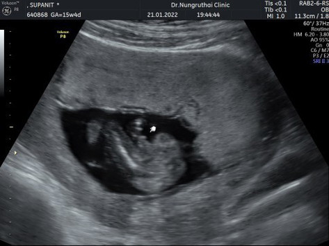 15week แบบนี้เพศชายจริงไหมคะเเม่ๆ