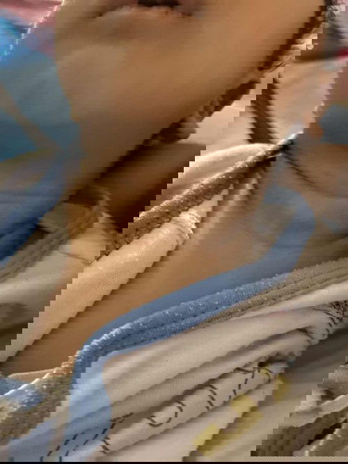 ทารกคอเป็นด่างขาว ต้องทำไงให้หายคะ