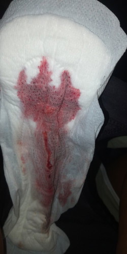 regla po ba ang ganito kadami at hindi implantation