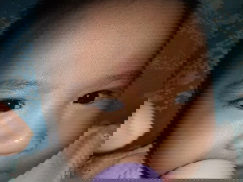 Bintik putih diwajah bayi