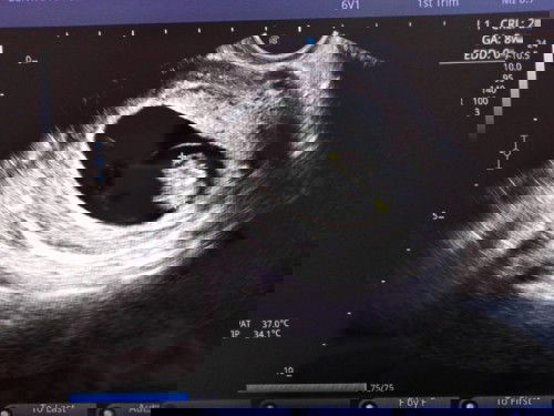 เย้ๆๆ เจอหัวใจน้องแล้ว คร้าาา ❤️❤️❤️