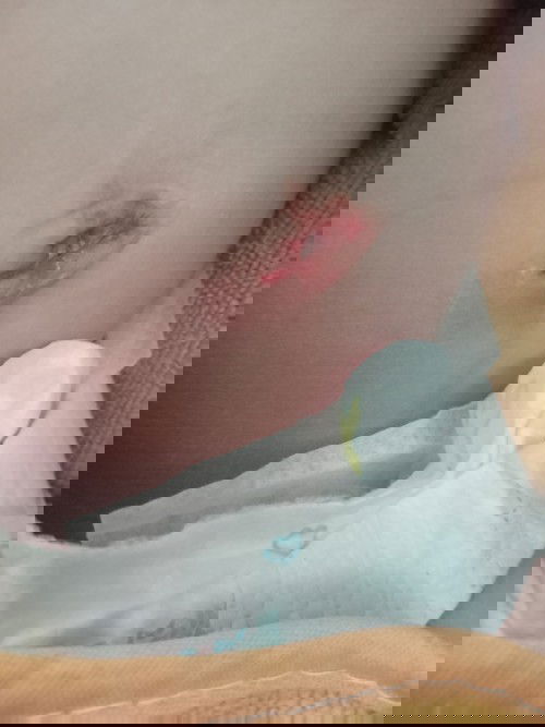 อันตรายมั้ยค่ะพอดีไม่รู้ว่าเกิดจากอะไรมาเห็นอีกทีตอนอาบน้ำเสร็จแล้วค่ะแม่ท่านไหนลูกเคยเป้นแบบนี้มั้ง