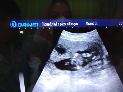 USG ada 2 kantong, tp yg terisi janin cuma 1. Yg 1 lg kosong