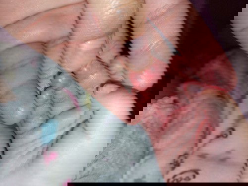 นิ้วมือลอกแล้วแดง