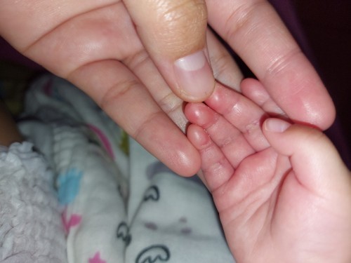 นิ้วมือลอกแล้วแดง