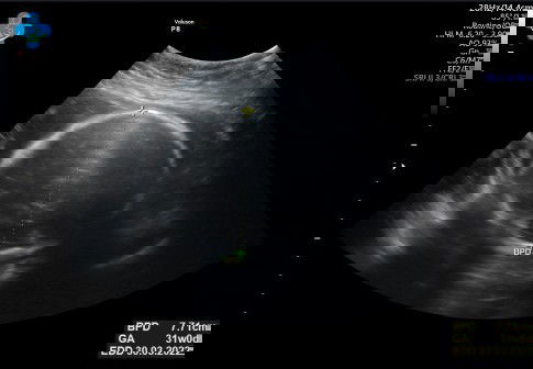 Usia janin di usg ebih besar dari usia kehamilan menurut hpht