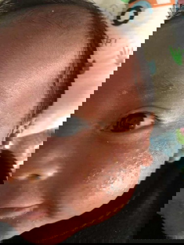 bun, ada yang anaknya pernah mengalami seperti ini ? anak saya usia 1 bulan.. wajahnya merah2 dan spt jerawat