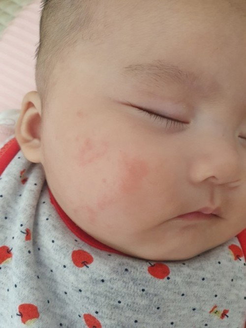 Bayi menagalami ruam air liur sampai kapan