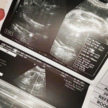 Ultrasound