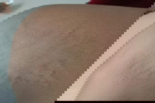 อาการผื่นคันตามแขนและขาช่วงตั้งครรภ์ไตรมาสแรกถือว่าปกติไหมคะ🤣