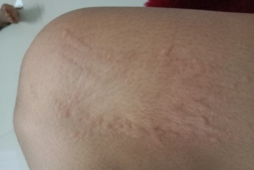 อาการผื่นคันตามแขนและขาช่วงตั้งครรภ์ไตรมาสแรกถือว่าปกติไหมคะ🤣