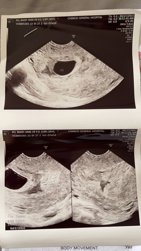 No bleeding. Ectopic