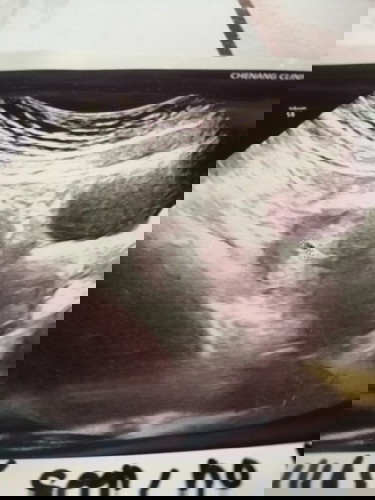 Sy scan 4weeks
Klau ikut skrg dh 6week
Tp td kluar darah period.tp tk bnyk sikit2 ja. Ada y mcm sy x