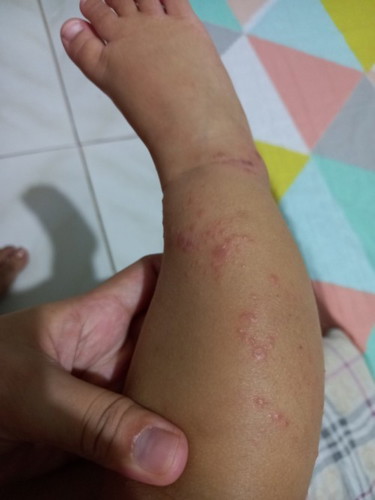 hi momshie ask lang sya di sya diaper rash .pero ngkaroon sya s kwatan na kati kati .ano pde gmitin?