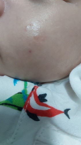 Bé e hôm nay 2m6d mặt bé nổi 1 đóm như này. E lo quá, có mom nào biết bé e bị gì k ạ!?
