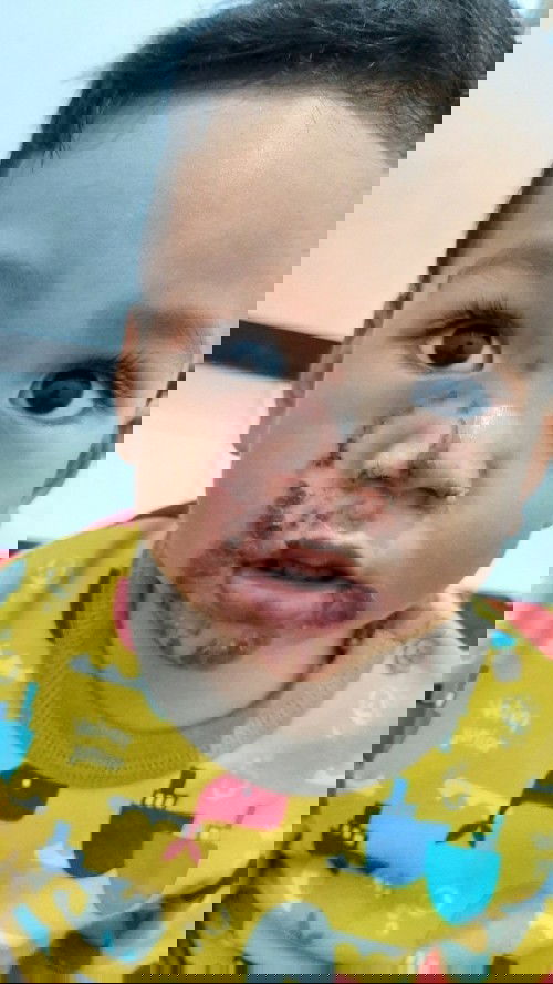 Herpes pada muka bayi 15 bulan