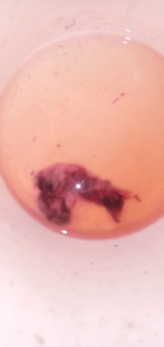 Im 6weeks pregnt. And im bleeding.ngpaultrasound aq. Wlng nkitang embryo. Ano n ky nngyri ky baby 😩