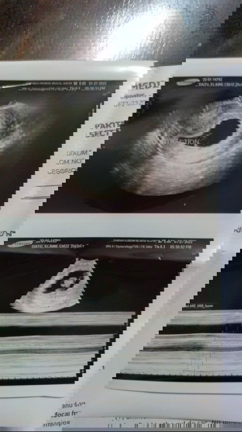 Myometrial Contraction