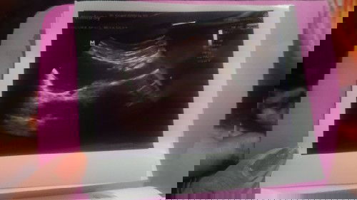 Bantu baca hasil usg