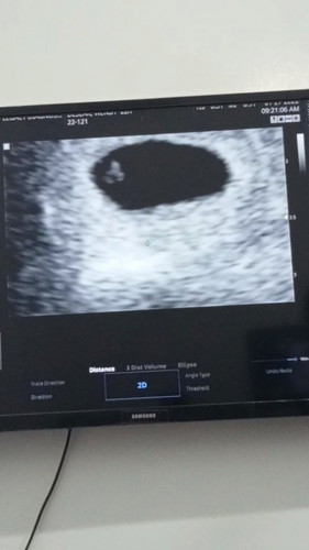 Pwede po ba magtanong 5weeks preggy napo Ako nag pa ultrasound po Ako Wala padaw po Sila marinig na