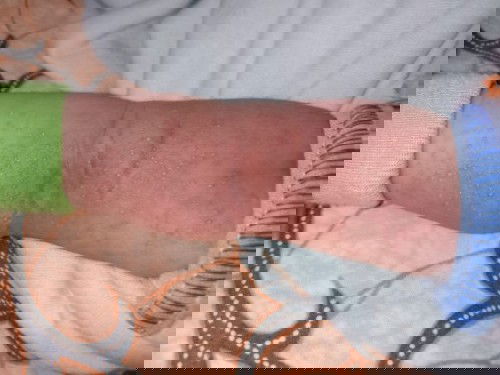 Kulit bayi bintik merah