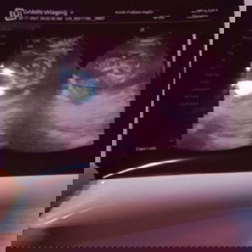 Hasil usg utun 12minggu 🥰
Alhamdulillah sehat .sekarang si utun udah masuk 21 minggu