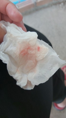 แม่ๆคะมีใครเลือดออกขณะท้องบ้างไหมคะ