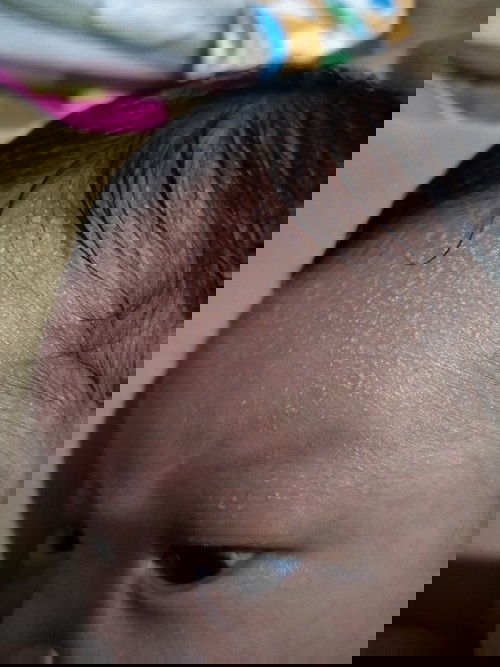 Bintik putih pada bayi nb