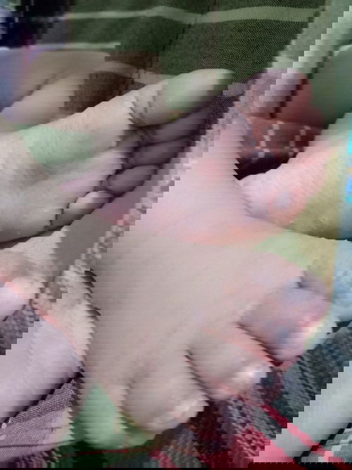 Kaki dan wajah ruam kemerahan