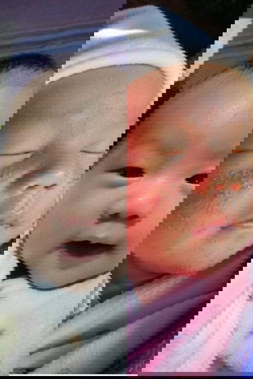 หน้าน้องเป็นผื่น