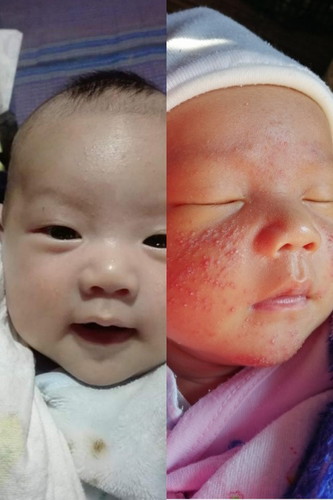 หน้าน้องเป็นผื่น