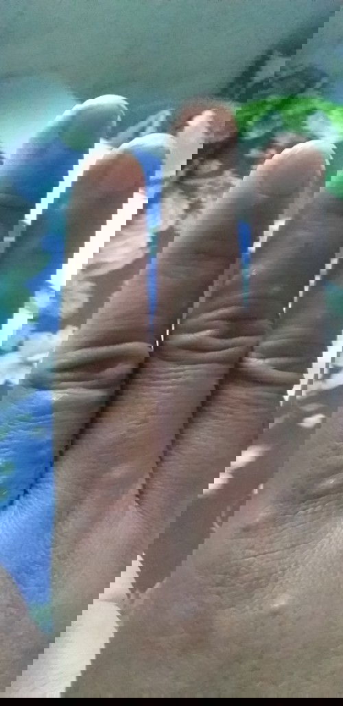 Cho hỏi mình mới sinh mổ hơn tuần mà tay nổi như vậy có sao ko ạ