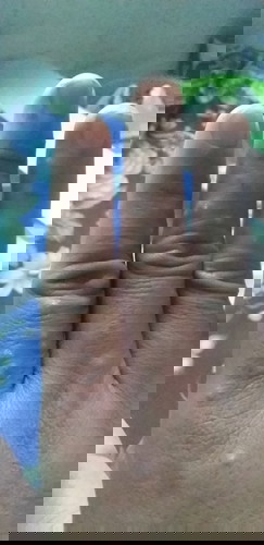 Cho hỏi mình mới sinh mổ hơn tuần mà tay nổi như vậy có sao ko ạ