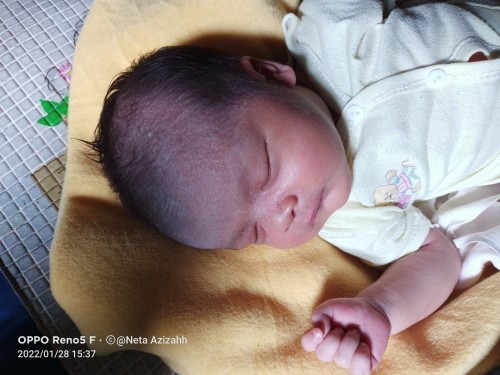 kulit kepala timbul biyang keringat lalu timbul bentol berair sperti melepuh