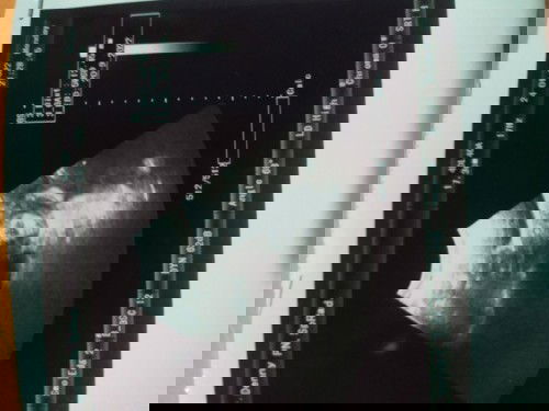 Usia kandungan hpht beda dg usg