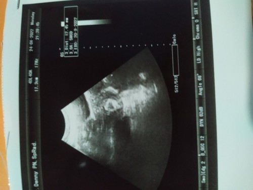 Usia kandungan hpht beda dg usg