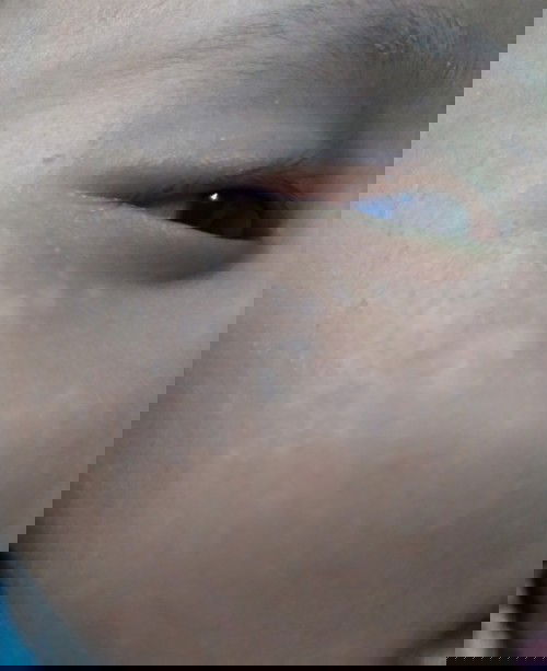 SEPERTI PANU DI WAJAH BAYI