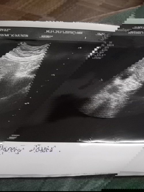 Kantung baby  tak bulat.