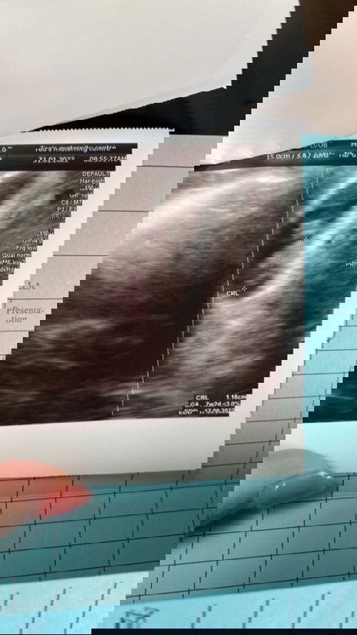 Scan baby 8weeks lepastu tadi scan dokter ubah 7w2day